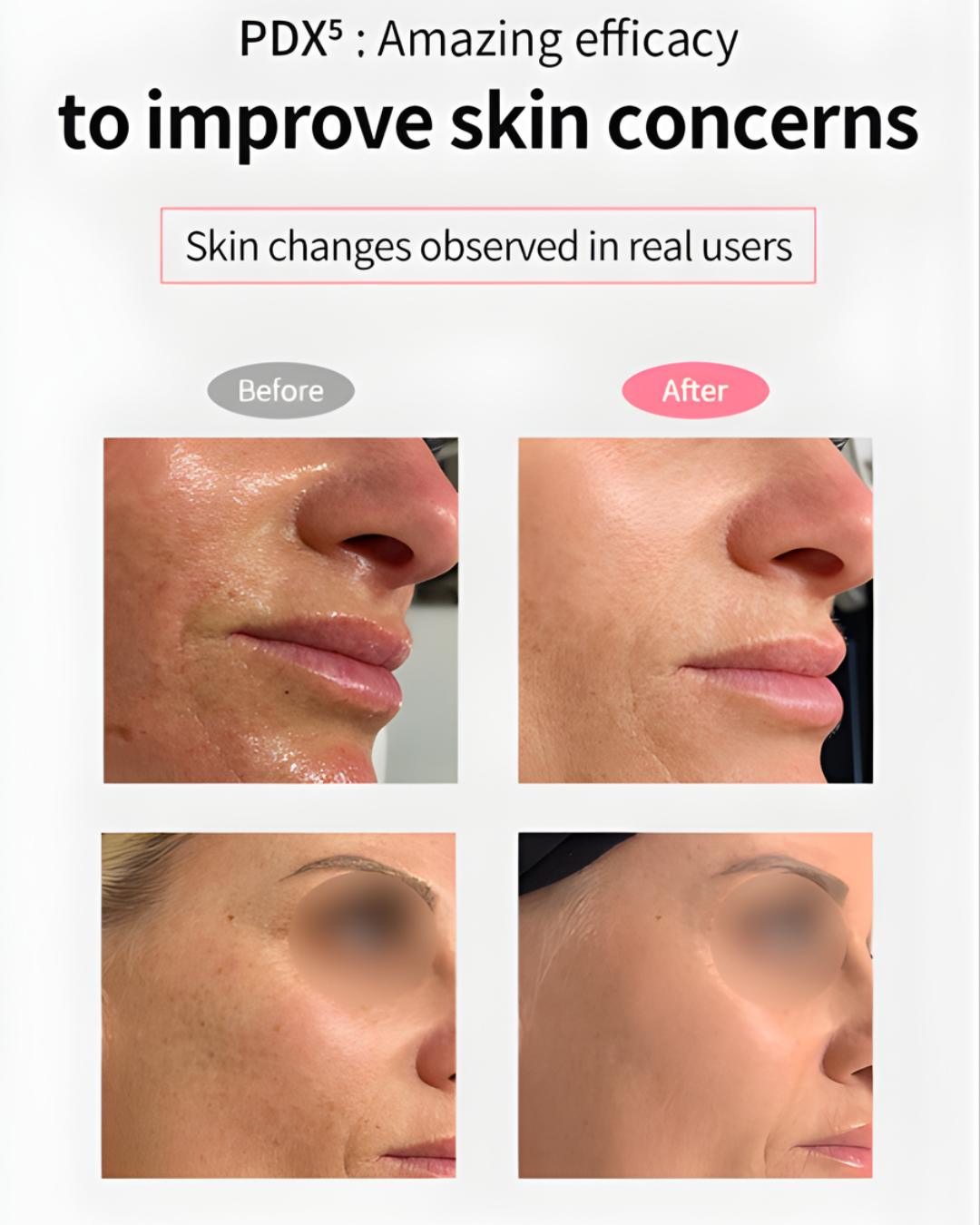 Dermaline PDX5 Skin Booster Total Solution (5ml x 5)