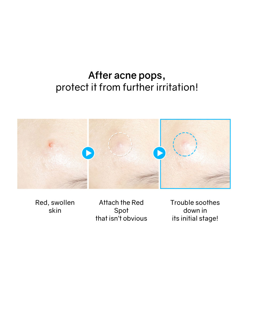 [PROMO] Hatherine Spot Care Patch Kit (76 patch)
